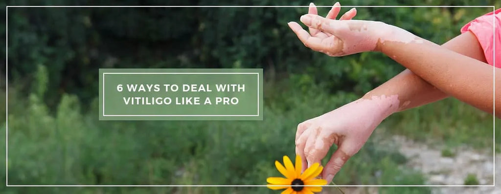6 Ultimate Ways To Deal With Vitiligo Like A PRO
