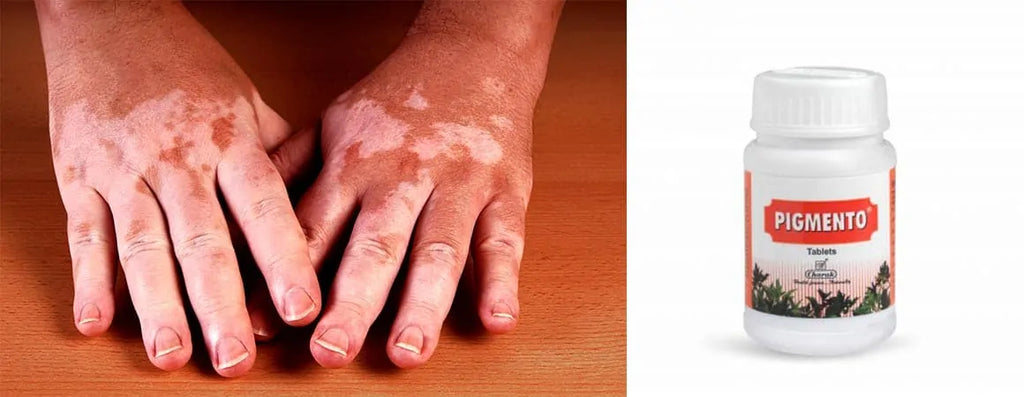 5 Natural Ways to Successfully Deal with Vitiligo