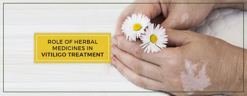 What is The Role Of Herbal Medicines In Vitiligo Treatment?