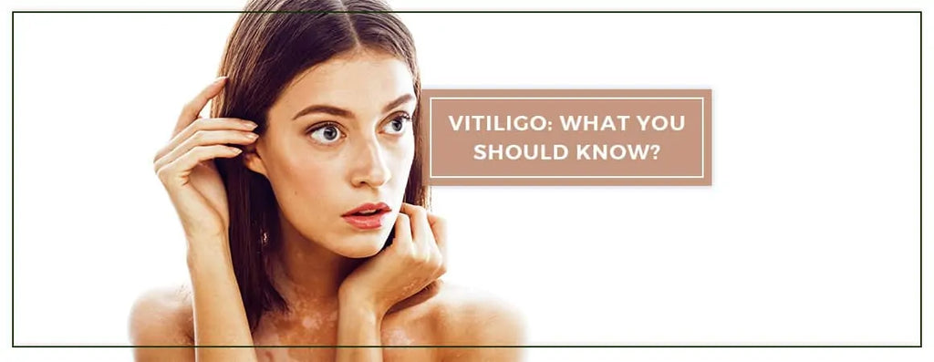 What is Vitiligo? What You Should Know?