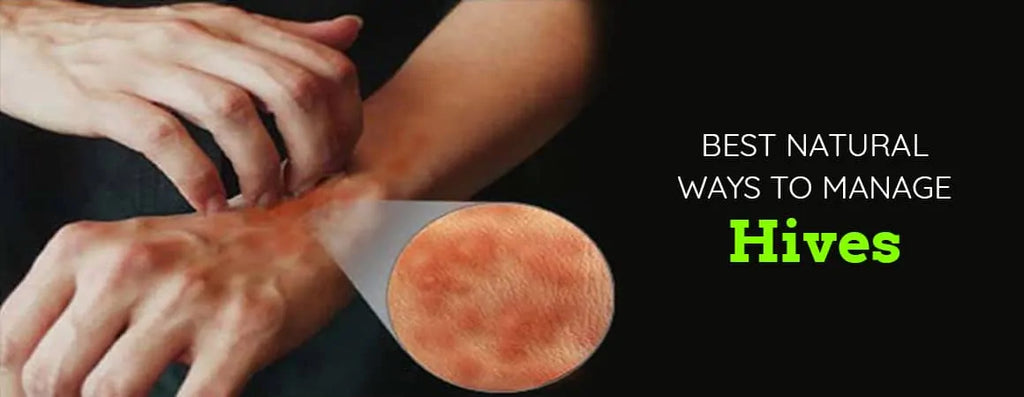 Best Natural Ways to Manage Hives