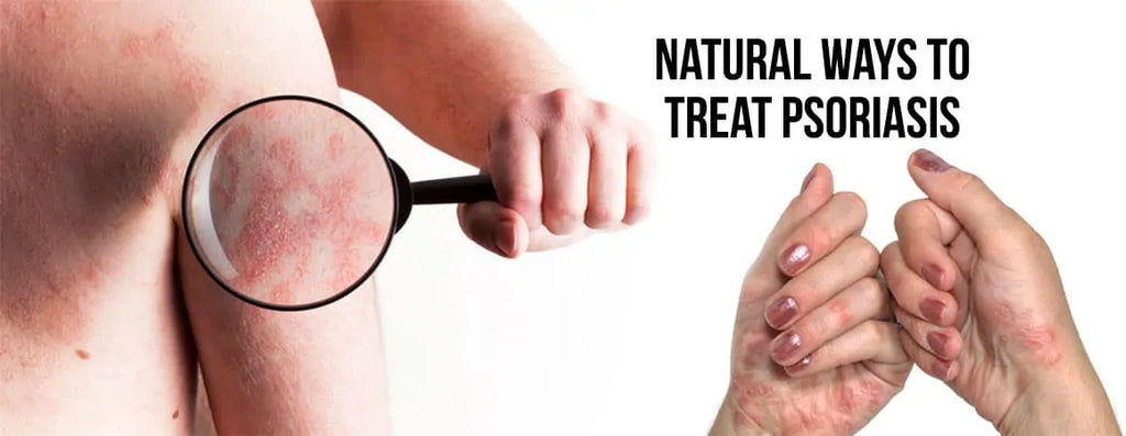 Natural Ways to Treat Psoriasis